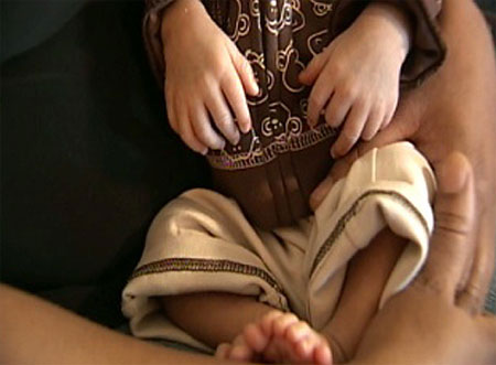 طفل 9 اشهر يخضع لاندر العمليات لازالة اصابعه الزائدة!!        صورة رقم 2