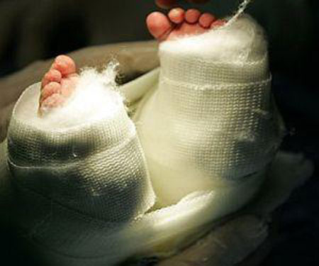 طفل 9 اشهر يخضع لاندر العمليات لازالة اصابعه الزائدة!!        صورة رقم 3