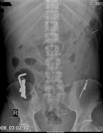 مواطن من حيفا يبتلع صندوق عدة! صورة رقم 1 مواطن من حيفا يبتلع صندوق عدة! صورة رقم 1