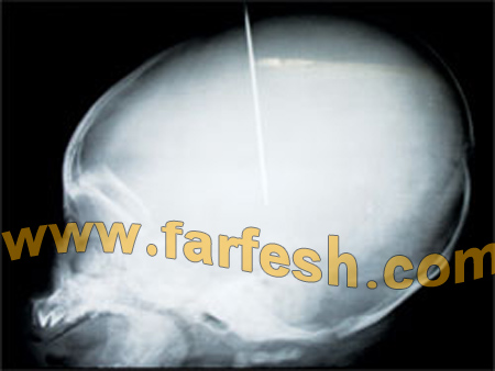 الغيرة دفعت فيتنامية لغرس إبرة في رأس ابن زوجها الرضيع  صورة رقم 8