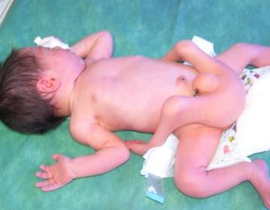 لله في خلقه شؤون: مولود سوري بأربع أرجل صورة رقم 1