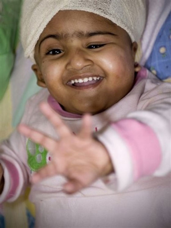 استيقاظ التوأم الثاني من عملية فصل ناجحة!!        صورة رقم 6