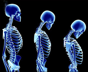 أكثر من 40% من نساء السعودية مصابات بهشاشة العظام صورة رقم 1