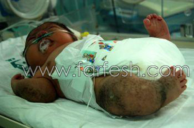 غزة: عجائب خاصة وطفرات جينية وتشوهات بسبب الفوسفور الأبيض صورة رقم 2