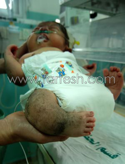 غزة: عجائب خاصة وطفرات جينية وتشوهات بسبب الفوسفور الأبيض صورة رقم 4