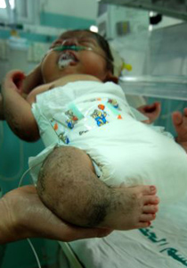 غزة: عجائب خاصة وطفرات جينية وتشوهات بسبب الفوسفور الأبيض صورة رقم 1