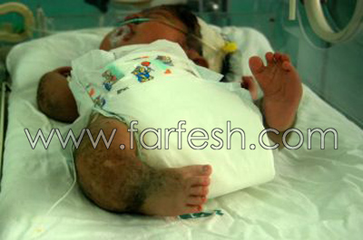 غزة: عجائب خاصة وطفرات جينية وتشوهات بسبب الفوسفور الأبيض صورة رقم 3