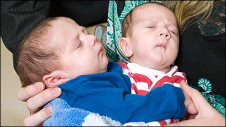 والدة التوأمين الملتصقين حسن وحسين: أتمنى حدوث معجزة  صورة رقم 2