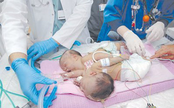 وفاة التوأم السيامي الفلسطيني في الرياض صورة رقم 1 وفاة التوأم السيامي الفلسطيني في الرياض صورة رقم 1