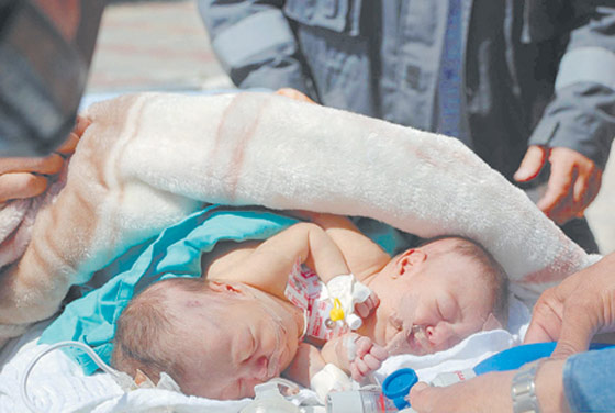 وفاة التوأم السيامي الفلسطيني في الرياض صورة رقم 3 وفاة التوأم السيامي الفلسطيني في الرياض صورة رقم 3