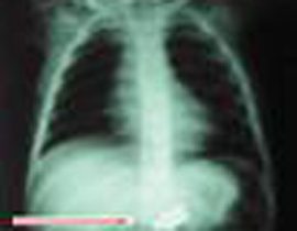 نسيان منظار معدني يبلغ طوله 18سم في رحم كويتية! صورة رقم 1 نسيان منظار معدني يبلغ طوله 18سم في رحم كويتية! صورة رقم 1