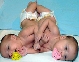 غدا ستجرى عملية لفصل التوأم السيامي الأردني محمد وأمجد! صورة رقم 1