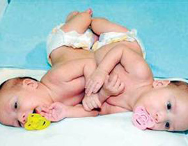 نجاح عملية فصل التوأم السيامي الاردني محمد وامجد  صورة رقم 1