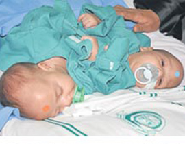 نجاح عملية فصل التوأم السيامي الاردني محمد وامجد  صورة رقم 2