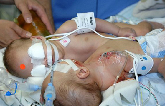 نجاح عملية فصل التوأم السيامي الاردني محمد وامجد  صورة رقم 7