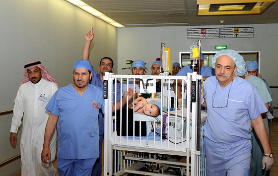 نجاح عملية فصل التوأم السيامي الاردني محمد وامجد  صورة رقم 5