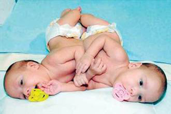 نجاح عملية فصل التوأم السيامي الاردني محمد وامجد  صورة رقم 4