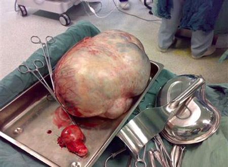 استئصال ورم سرطاني من بطن سيدة يعادل وزن 4 مواليد!! صورة رقم 1