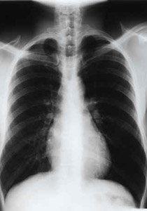 توفيت من التخين بسبب رئة رجل غريب! صورة رقم 1