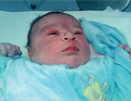 استئصال ورم من كلية جنين! صورة رقم 1 استئصال ورم من كلية جنين! صورة رقم 1