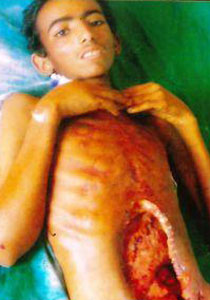 فضيحة طبية في اليمن: ترك بطن طفل مفتوحة 20 يوما ادت لوفاته! صورة رقم 1 فضيحة طبية في اليمن: ترك بطن طفل مفتوحة 20 يوما ادت لوفاته! صورة رقم 1