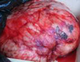 استئصال اكبر طحال بالعالم يزن 20 كيلو غرام! صورة رقم 1