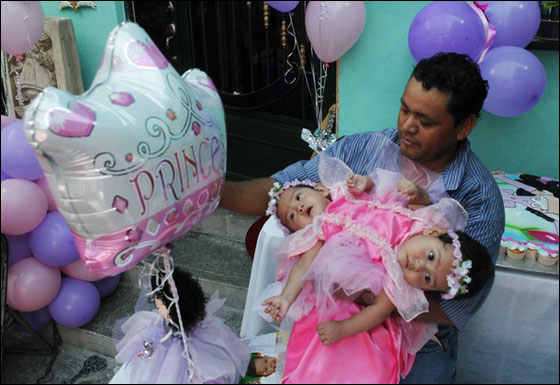 التوأم السيامي ماريا وإلسا تحتفلان بميلادهما الأول قبل فصلهما صورة رقم 2 التوأم السيامي ماريا وإلسا تحتفلان بميلادهما الأول قبل فصلهما صورة رقم 2