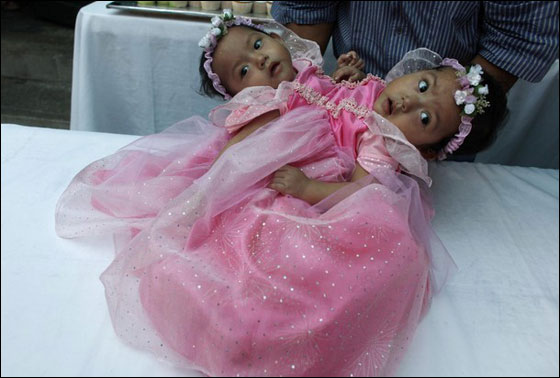 التوأم السيامي ماريا وإلسا تحتفلان بميلادهما الأول قبل فصلهما صورة رقم 1 التوأم السيامي ماريا وإلسا تحتفلان بميلادهما الأول قبل فصلهما صورة رقم 1