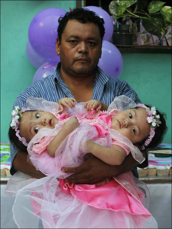 التوأم السيامي ماريا وإلسا تحتفلان بميلادهما الأول قبل فصلهما صورة رقم 3 التوأم السيامي ماريا وإلسا تحتفلان بميلادهما الأول قبل فصلهما صورة رقم 3