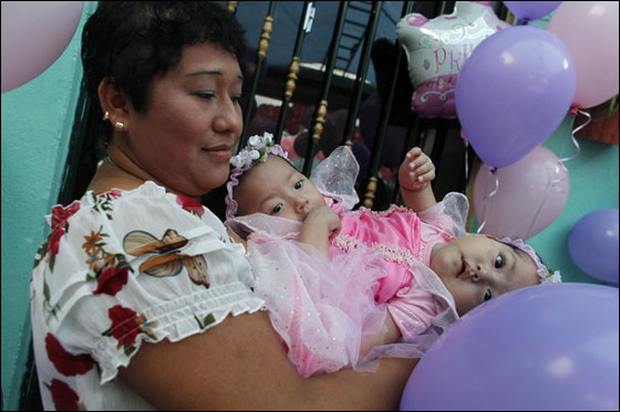 التوأم السيامي ماريا وإلسا تحتفلان بميلادهما الأول قبل فصلهما صورة رقم 4 التوأم السيامي ماريا وإلسا تحتفلان بميلادهما الأول قبل فصلهما صورة رقم 4