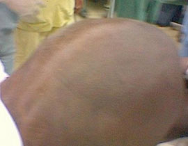 مستشفى سعودي يدخل غينيس باستئصال اكبر كيس مائي! صورة رقم 1