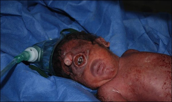 هل هو المسيح لدجال!! مولود عراقي بعين واحدة في جبينه! صورة رقم 3 هل هو المسيح لدجال!! مولود عراقي بعين واحدة في جبينه! صورة رقم 3