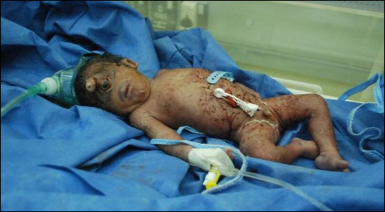 هل هو المسيح لدجال!! مولود عراقي بعين واحدة في جبينه! صورة رقم 5 هل هو المسيح لدجال!! مولود عراقي بعين واحدة في جبينه! صورة رقم 5