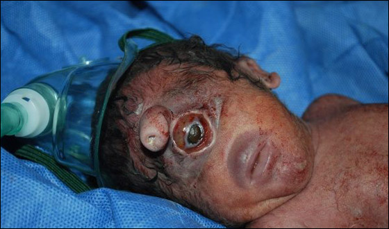 هل هو المسيح لدجال!! مولود عراقي بعين واحدة في جبينه! صورة رقم 4 هل هو المسيح لدجال!! مولود عراقي بعين واحدة في جبينه! صورة رقم 4