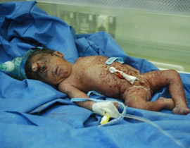 هل هو المسيح لدجال!! مولود عراقي بعين واحدة في جبينه! صورة رقم 1 هل هو المسيح لدجال!! مولود عراقي بعين واحدة في جبينه! صورة رقم 1