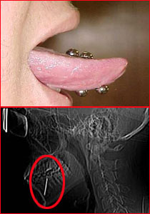 شاب يثقب لسانه لوضع حلق فيه ويخضع لعملية معقدة! صورة رقم 1