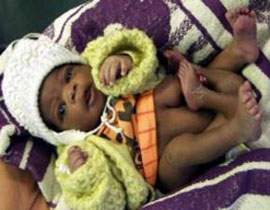 حالة نادرة..مولود يمني له أربع أيد وثلاث أرجل!! صورة رقم 1