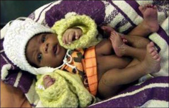 حالة نادرة..مولود يمني له أربع أيد وثلاث أرجل!! صورة رقم 2