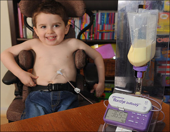 منذ ولادته وحتى سن الرابعة لا يأكل من فمه! صورة رقم 5 منذ ولادته وحتى سن الرابعة لا يأكل من فمه! صورة رقم 5