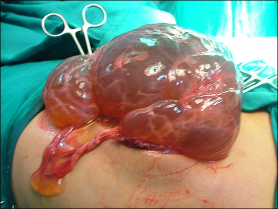 بالصور.. استئصال ورم يزن 7 كيلو من بطن طفل!  صورة رقم 2