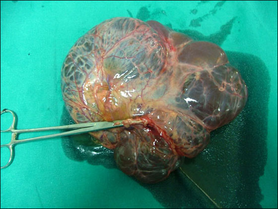 بالصور.. استئصال ورم يزن 7 كيلو من بطن طفل!  صورة رقم 3