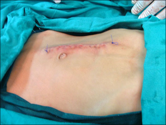 بالصور.. استئصال ورم يزن 7 كيلو من بطن طفل!  صورة رقم 5