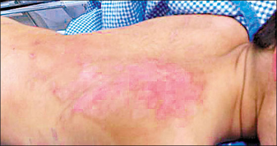 طفلان اشعلا زجاجة مبيد حشري احتفالا بحفل زفاف فحرقا طفلا! صورة رقم 1