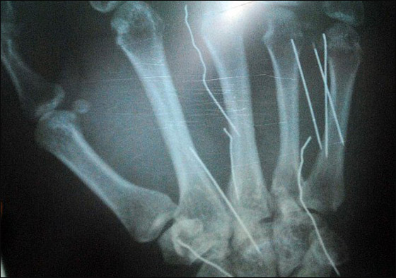 للمرة الثانية في الخليج.. رجل يغرس 14 مسماراً في جسد خادمتة! صورة رقم 1 للمرة الثانية في الخليج.. رجل يغرس 14 مسماراً في جسد خادمتة! صورة رقم 1