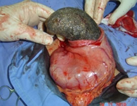 عانت من الام دائمة.. فاخرج الاطباء كتلة شعر من بطنها! صورة رقم 1