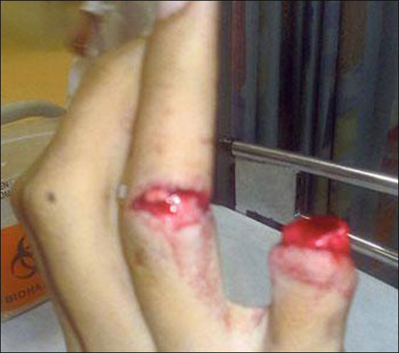 السعودية: عاقبوه ببتر اصبعه والسبب.. ضربة جزاء!! صورة رقم 2