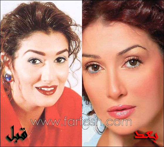 في 2010.. النجمات وعمليات التجميل بين الموضة والاكتئاب! صورة رقم 3 في 2010.. النجمات وعمليات التجميل بين الموضة والاكتئاب! صورة رقم 3