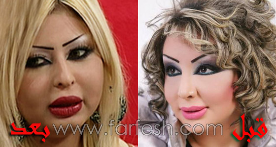 في 2010.. النجمات وعمليات التجميل بين الموضة والاكتئاب! صورة رقم 6 في 2010.. النجمات وعمليات التجميل بين الموضة والاكتئاب! صورة رقم 6