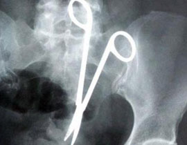 آلام شديدة كشفت عن وجود مقص في بطن مريض منذ 7 سنوات! صورة رقم 1