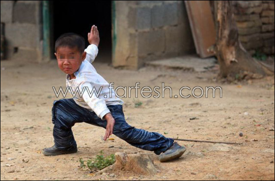 قصة مدهشة عن يتيم ينبذه مجتمعه لمرضه ويعيش وحيدا!  صورة رقم 14